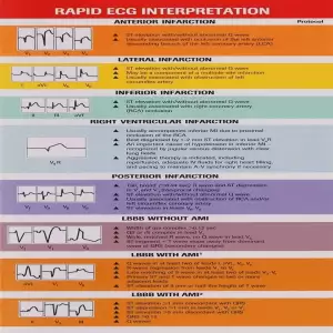 Rapid ECG Interpretation